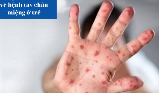 Những triệu chứng của bệnh tay chân miệng ở trẻ