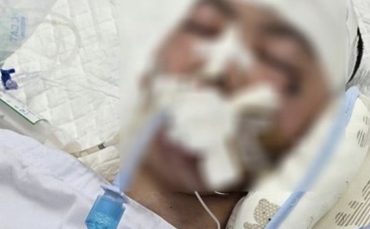 Nam sinh lớp 8 bị đánh chấn thương sọ não tử vong