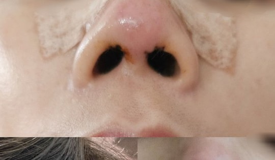 Thảm họa làm đẹp khi đến nhầm chỗ (bài 8): Viện Thẩm mỹ Quốc tế Changwon, số 10 Vũ Trọng Phụng khiến khách hàng nâng mũi phải tháo sụn vì mưng mủ kéo dài