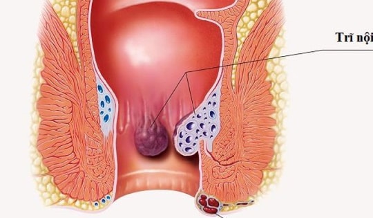 Bài tập giảm tái phát cho người bệnh trĩ