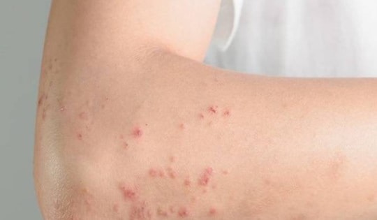 Ngứa da uống thuốc dị ứng không đỡ, cẩn thận với nhiễm giun đũa chó mèo