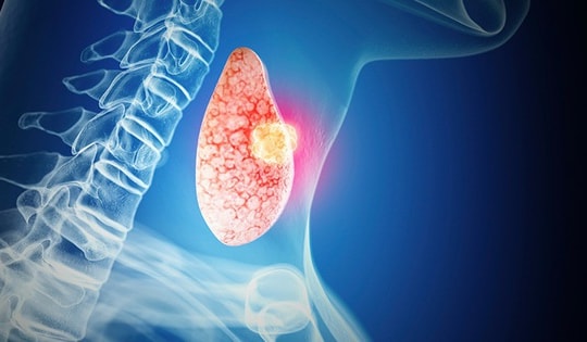 Ai có nguy cơ mắc ung thư tuyến giáp?