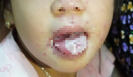 Bé gái bị nhiễm trùng nặng, miệng không thể ăn uống do mắc thủy đậu