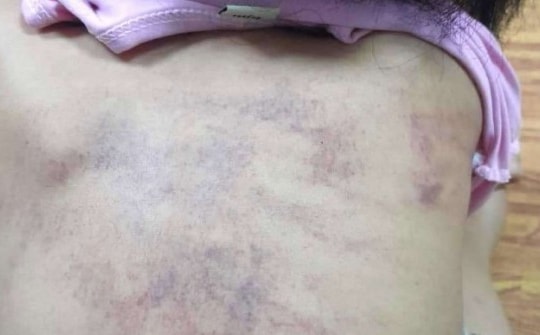 Vụ bé 5 tuổi ở Hải Phòng bầm tím khi đi học: Bị bạn đấm 20 lần vào lưng, gáy