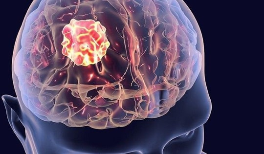 6 dấu hiệu cảnh báo u não