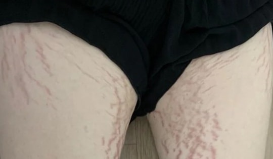 Cô gái 23 tuổi ở Hà Nội bị suy tuyến thượng thận vì dùng thuốc xịt mũi theo cách này