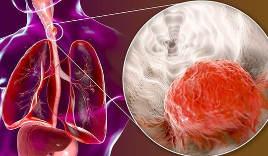 Chế độ ăn cho bệnh nhân ung thư thực quản