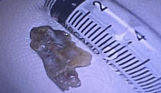 Mảnh xương 2,5 cm nằm trong phế quản người đàn ông suốt 3 năm