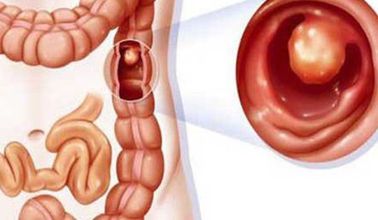 Điều trị ung thư đại tràng như thế nào?