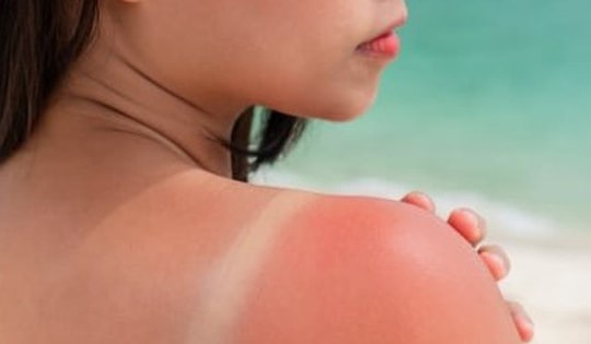 Lưu ý để tránh da cháy nắng, sạm đen khi đi biển