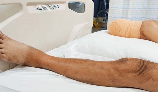 Người đàn ông mắc bệnh tiểu đường bất ngờ phải cắt cụt chân chỉ vì lấy khóe móng chân theo cách này