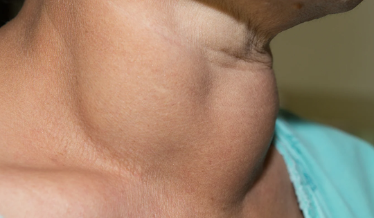 5 điều nhất định phải biết khi bị bướu cổ