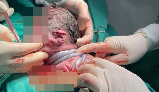Em bé ở Hà Nội chào đời với dây rốn quấn 3 vòng cổ