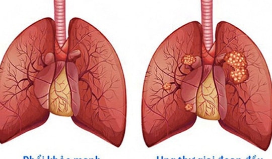 Cách tập luyện ở người mắc bệnh ung thư phổi