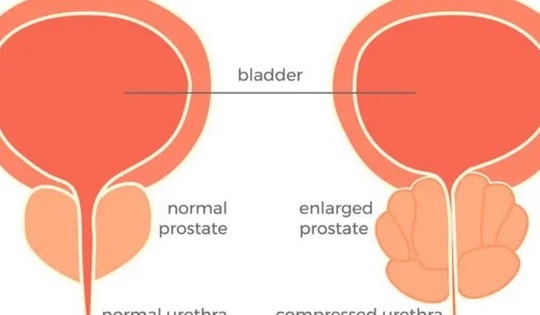 Các phương pháp laser điều trị phì đại tuyến tiền liệt