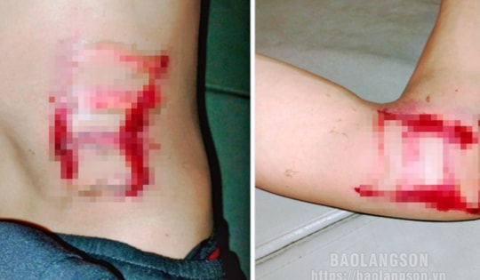 Thanh niên 29 tuổi ở Lạng sơn bị sét đánh ngất ngay trong phòng ngủ, lúc nửa đêm