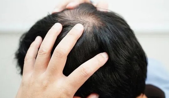 Rụng tóc kiểu 'rừng thưa', nam thanh niên bất ngờ phát hiện bệnh lây truyền qua đường tình dục