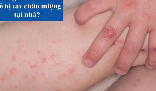 Lưu ý gì khi chăm sóc trẻ bị tay chân miệng tại nhà?