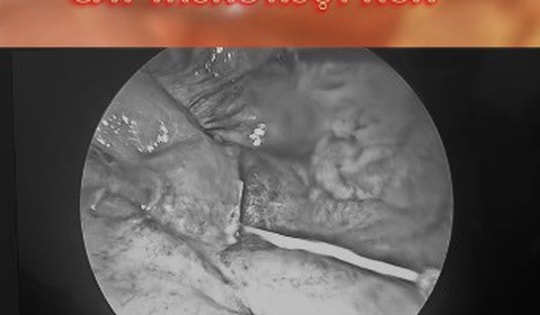 Người đàn ông 55 tuổi ở Phú Thọ bất ngờ bị thủng ruột sau khi ăn cơm cá