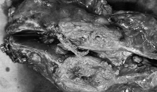 Tưởng u thận, người phụ nữ 66 tuổi tá hỏa khi bác sĩ lấy ra dị vật này khỏi ổ bụng suốt 14 năm