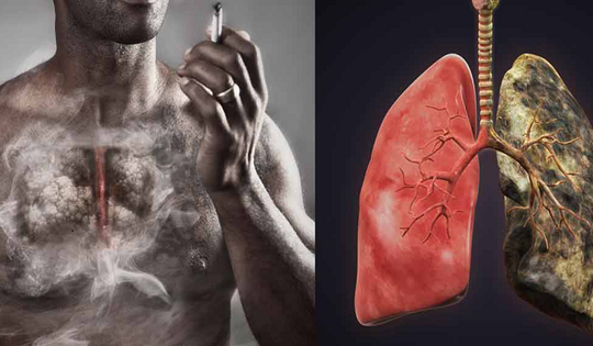 Ung thư phổi có biểu hiện gì, bao lâu nên đi khám 1 lần?