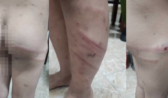 Phú Thọ: Bé trai 11 tuổi bị mẹ ruột và bạn trai bạo hành giữa đêm