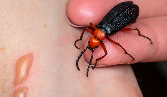 Ăn loại côn trùng được đồn thổi giúp tăng cường sinh lý, người đàn ông đái ra máu, suy thận cấp