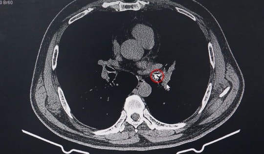 Người đàn ông 52 tuổi ở Quảng Ninh bất ngờ với thứ được gắp ra từ phế quản sau khi ho cả tháng