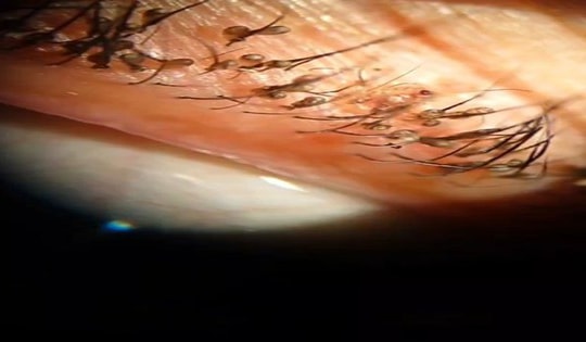 Người phụ nữ vào viện bất ngờ với mi mắt chi chít rận mu ký sinh, nguyên nhân khiến chị em càng giật mình