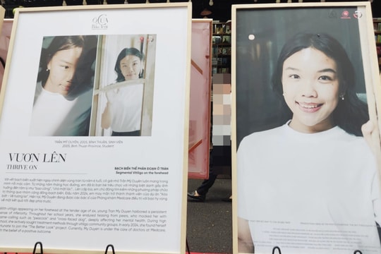 Cuộc sống mới của cô gái mắc bệnh bạch biến từng bị bạn bè xa lánh