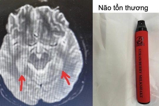 Nam sinh tổn thương não, tim vì hút thuốc lá điện tử trộn ma túy