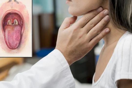 Bệnh bạch hầu là gì? Công ty có bắt buộc phải tổ chức xét nghiệm bệnh bạch hầu cho nhân viên?