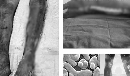 Đi làm ruộng với vết thương hở ở chân, người đàn ông 64 tuổi ở Nam Định sốc nhiễm khuẩn, suy đa tạng