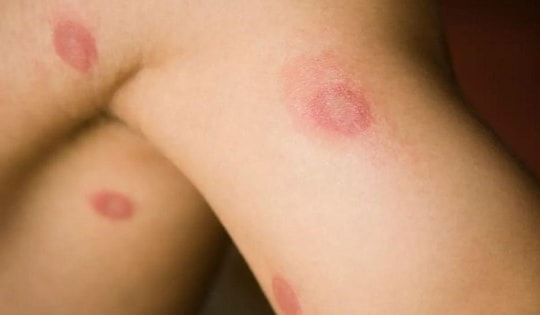 Nóng: Phát hiện chủng nấm mới dễ lây truyền qua đường tình dục