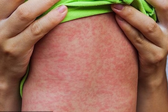 Bộ Y tế chỉ đạo nóng ngăn chặn bùng phát dịch sởi, ho gà