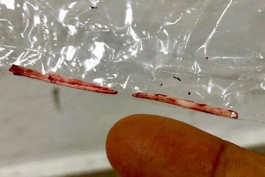 Sốt 7 ngày không giảm, đi khám phát hiện 'vật thể lạ' trong gan