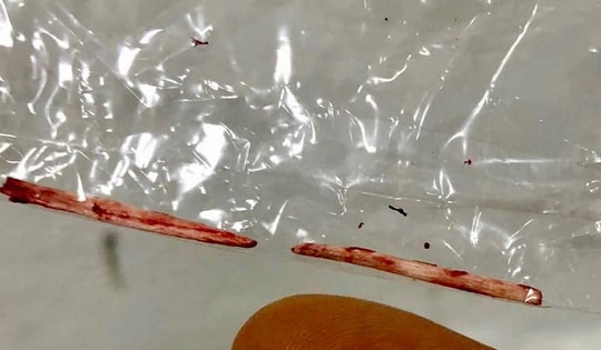 Sốt cao 7 ngày kèm đau bụng, nam thanh niên ở Hà Nội bất ngờ được bác sĩ lấy ra dị vật này ở gan