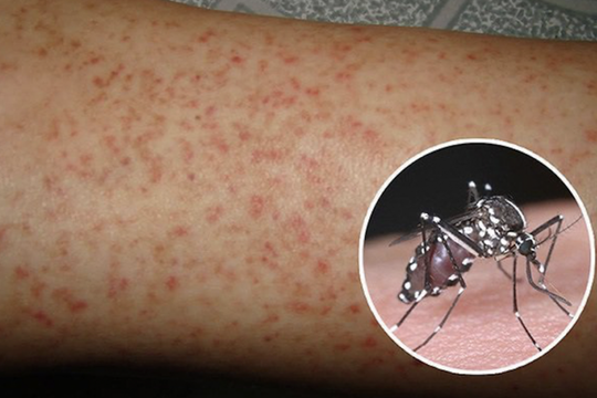 Hà Nội ghi nhận thêm 11 ổ dịch sốt xuất huyết trong một tuần