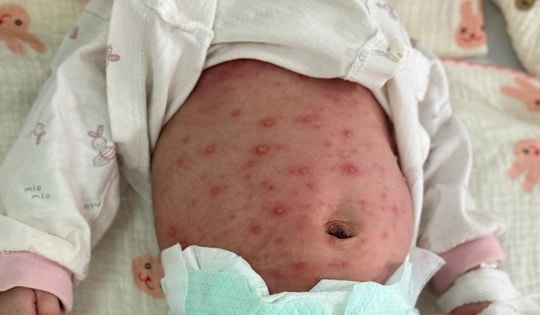 Bé trai 5 ngày tuổi ở Hà Nội bị phỏng nước dày đặc toàn thân do lây thủy đậu từ mẹ