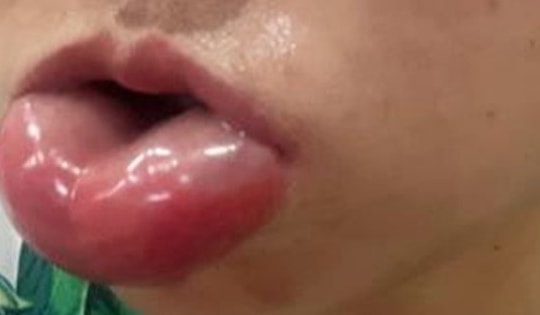 Môi sưng mọng như quả cà chua sau tiêm meso trẻ hóa