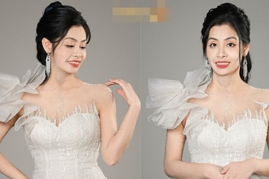 Cuộc sống mới của người phụ nữ từng bị chồng tạt axit để lại vết sẹo hơn 30cm