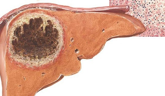 6 câu hỏi thường gặp về bệnh áp xe gan do amip