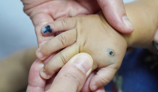 Chăm sóc trẻ bị chốc lở, cha mẹ cần biết điều này