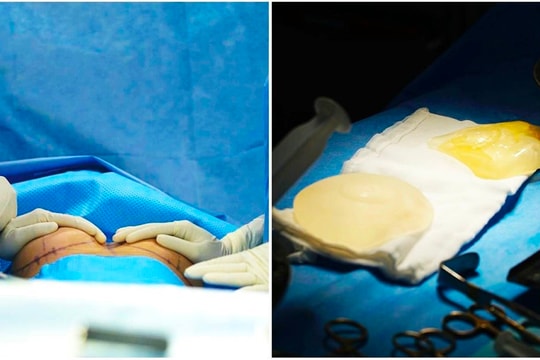 Nâng ngực - Kỹ thuật tạo hình khoang chính xác bằng dao siêu âm