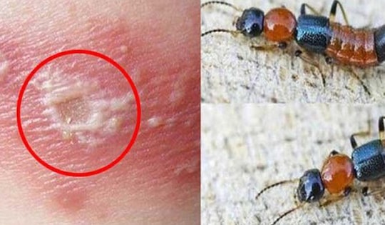 Nhiều ca viêm da tiếp xúc do kiến ba khoang, cách nhận biết và xử trí đúng