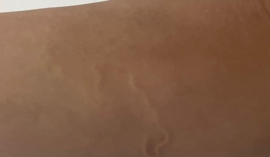 Nam thanh niên 21 tuổi nhiễm ký sinh trùng khắp người vì thói quen ăn món khoái khẩu này