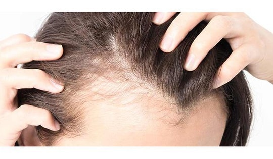 Thuốc điều trị rụng tóc do bệnh tuyến giáp