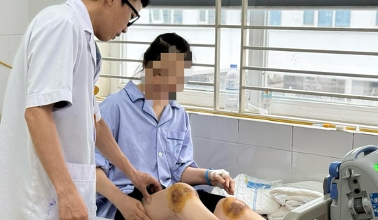 Người phụ nữ 43 tuổi nhiễm khuẩn huyết, hoại tử chân sau khi dùng ong đốt chữa bệnh khớp