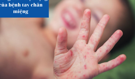 Những biểu hiện nặng của bệnh tay chân miệng - Cha mẹ chớ xem thường!