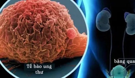 Câu hỏi thường gặp liên quan đến ung thư bàng quang